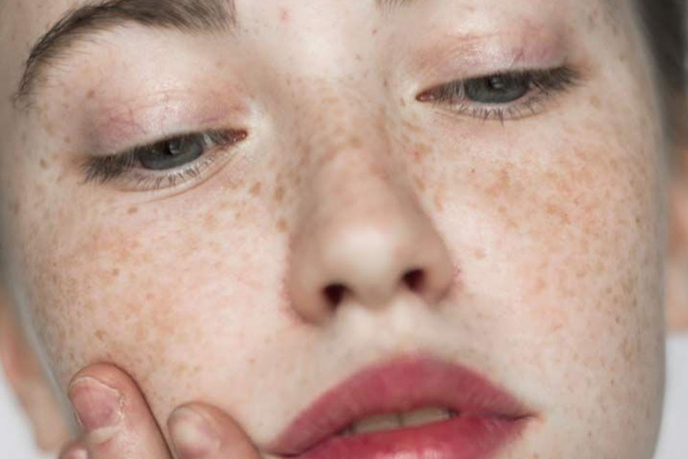 Pigment spots and exfoliation in winter