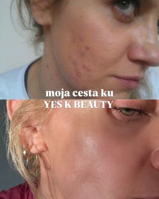 príbeh YES K-BEAUTY #skin #story #acne #yeskbeauty