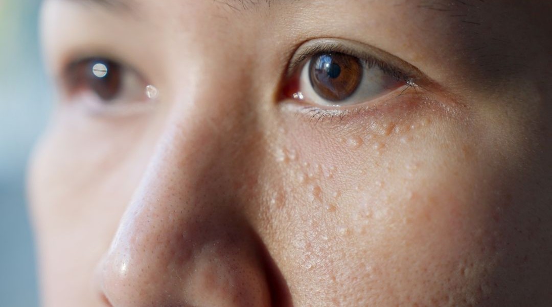 Mílie: co jsou zač, proč vznikají a jak je bezpečně odstranit