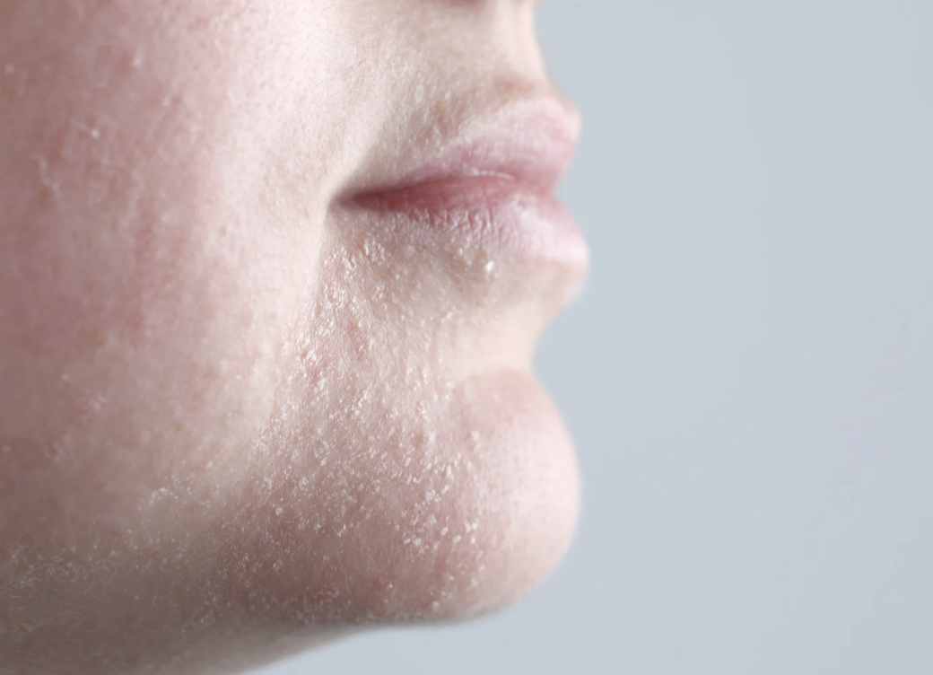 Jak pečovat v zimě o suchou pleť