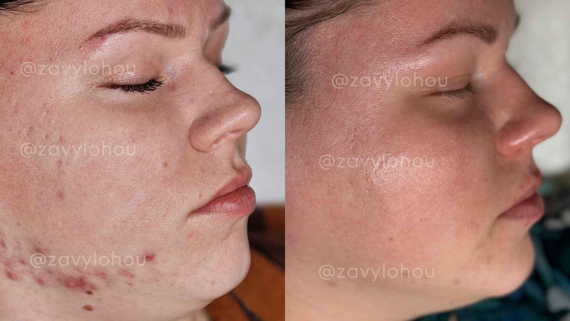 Akné + jizvičky po akné 30