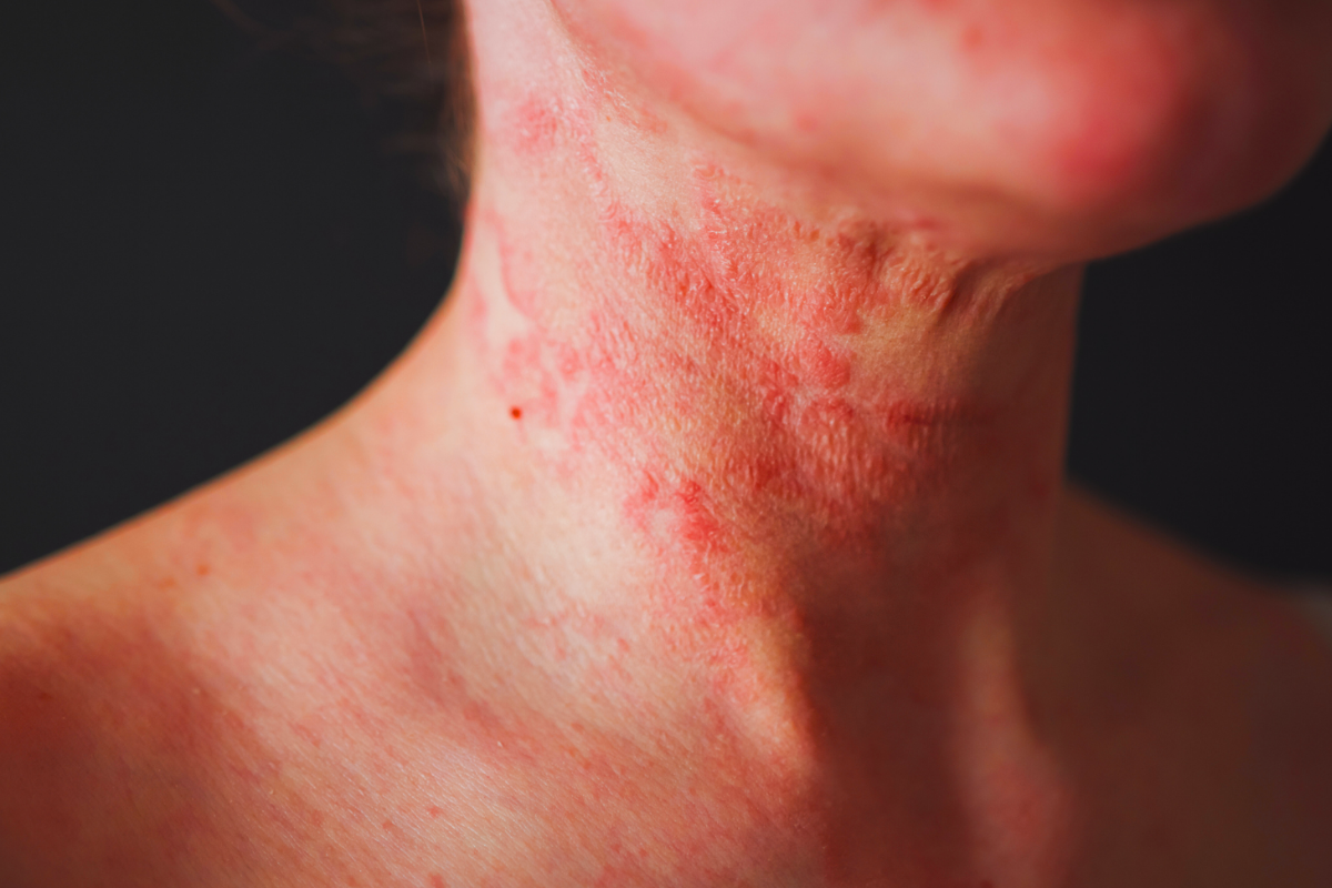 Живот след кортикостероиди: Как да се справим с TSW и да върнем спокойствието на кожата?