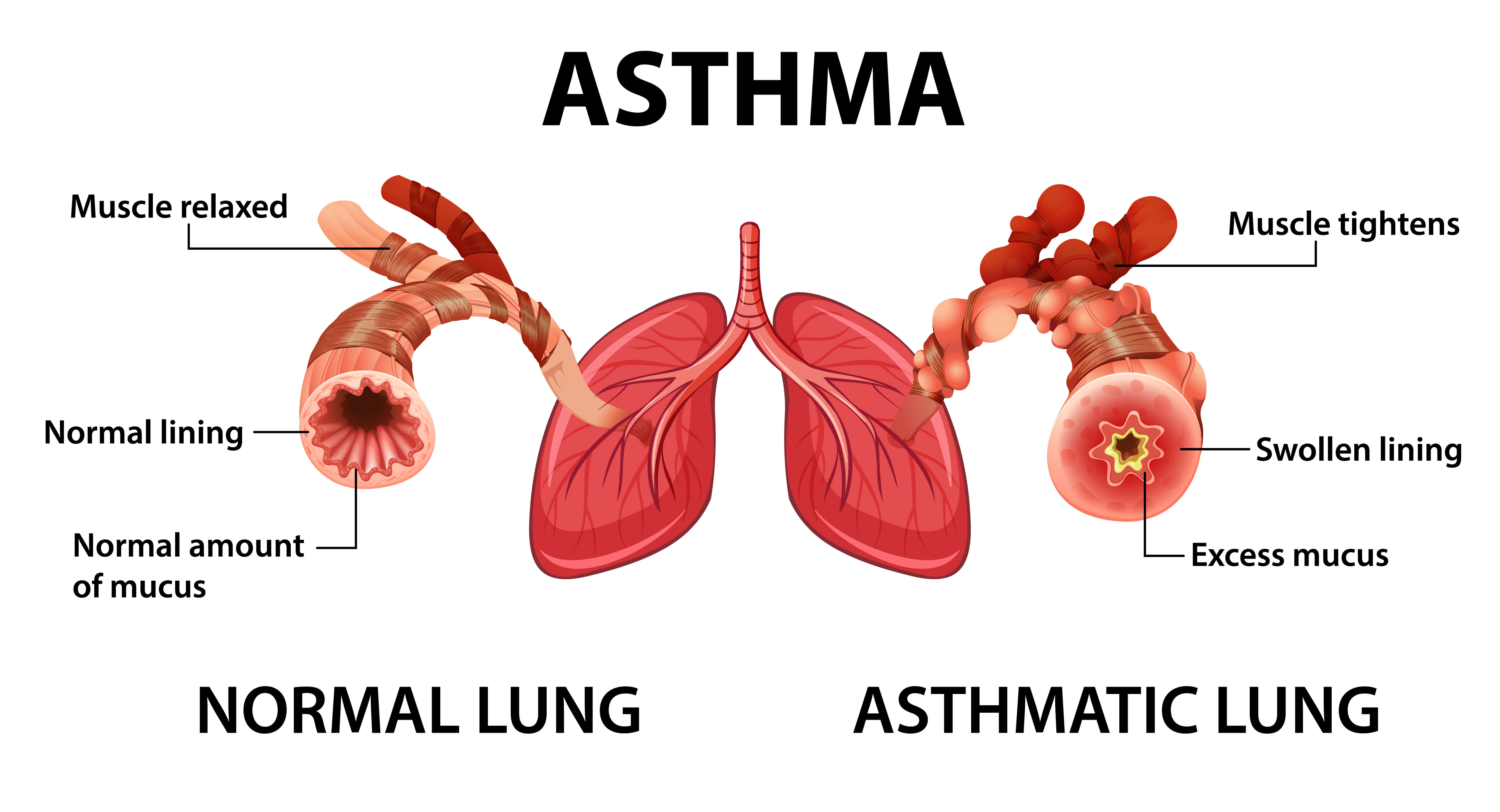 plice-astma
