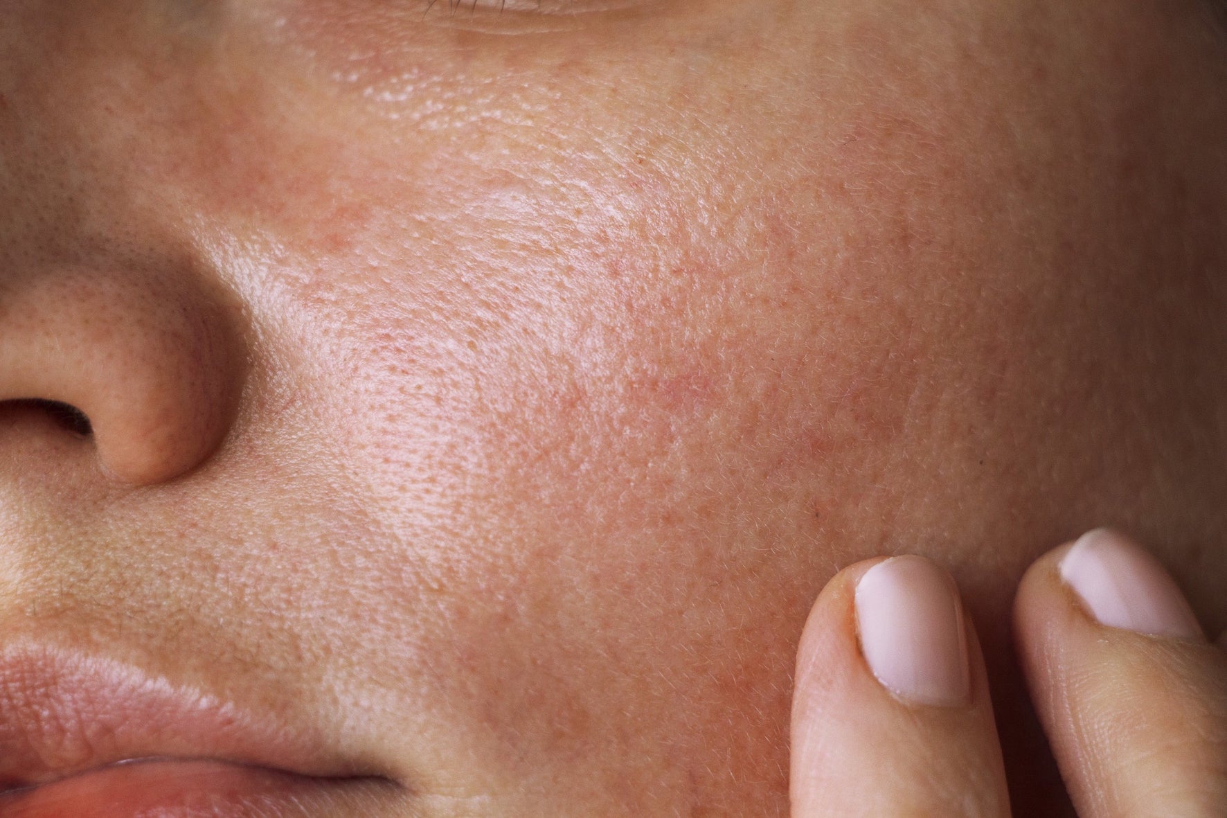 Dermatitida