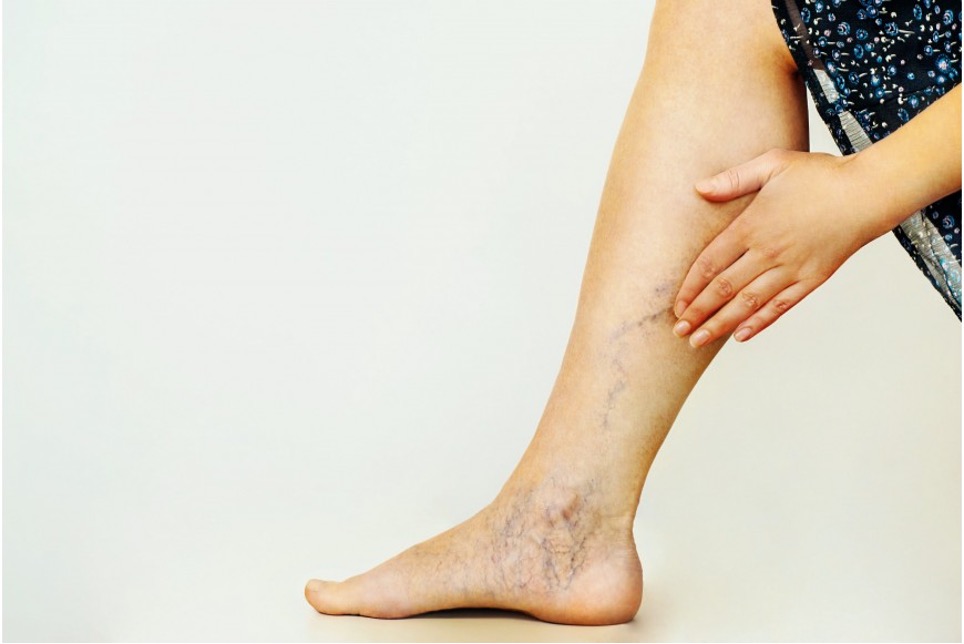 Křečové žíly a kompresní terapie