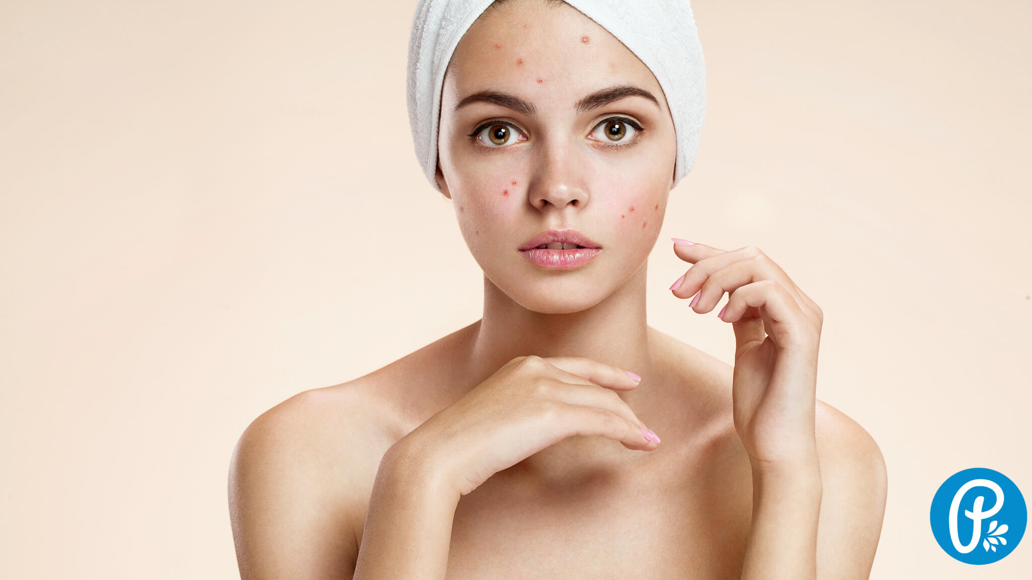 Funguje prírodná kozmetika na akné?