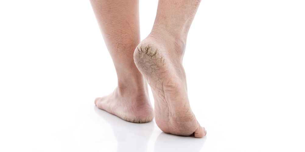 Praskliny na patách: domácí léčba s ureou + prevence bez žiletek