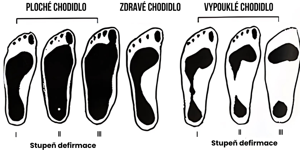 Ploché nohy: jak je odhalit doma a jak vybrat správné vložky pro zdravou chůzi