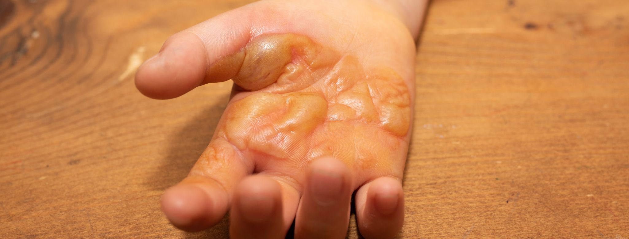 Co na popáleniny od oleje a vody?