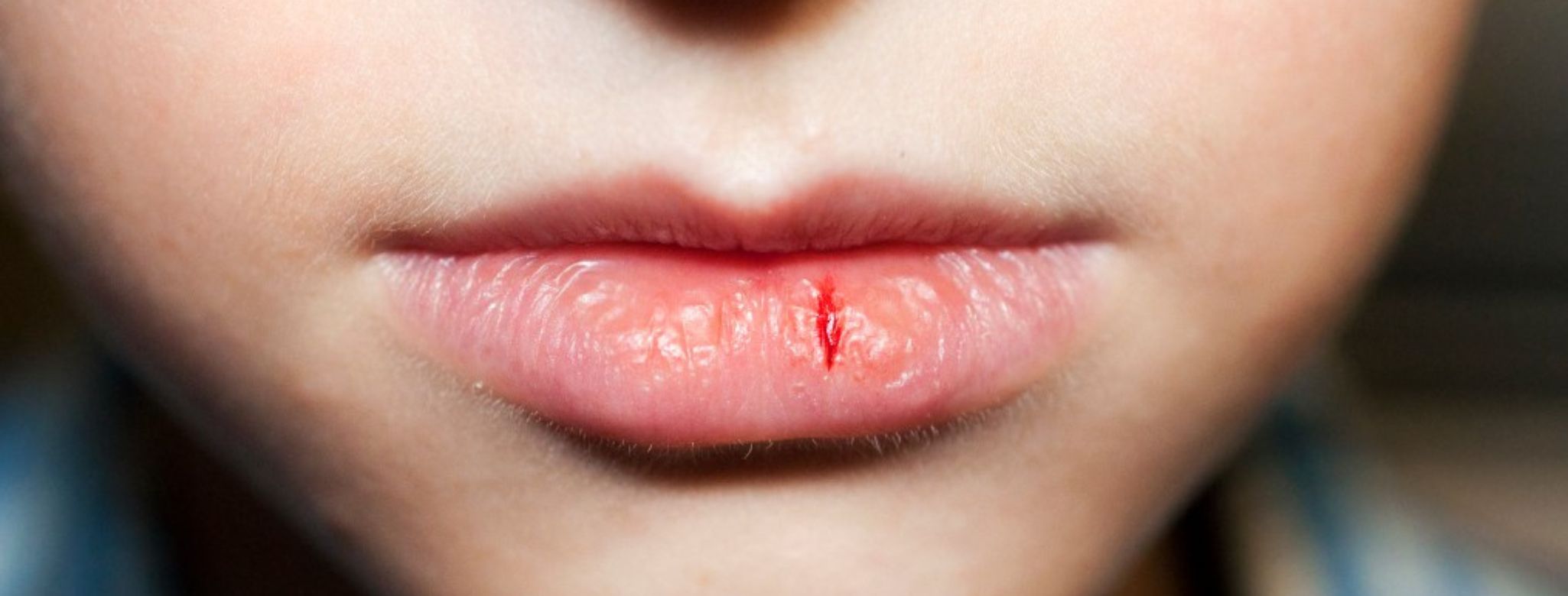 Suché a popraskané rty: Příčina a léčba