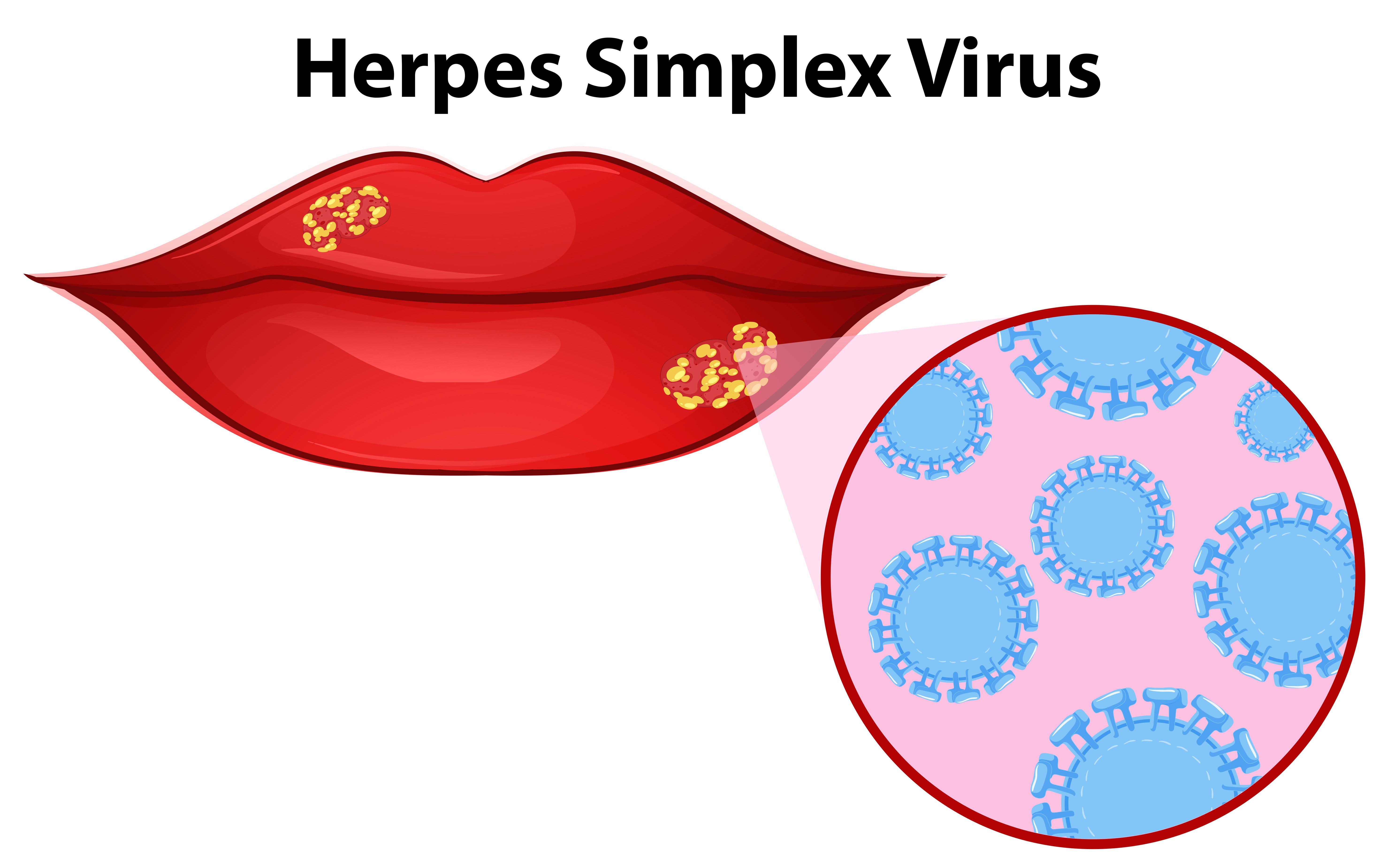co-je-herpes-siplex