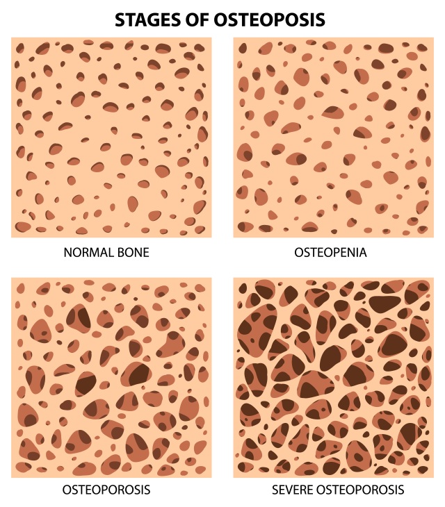 stadia-osteoporozy