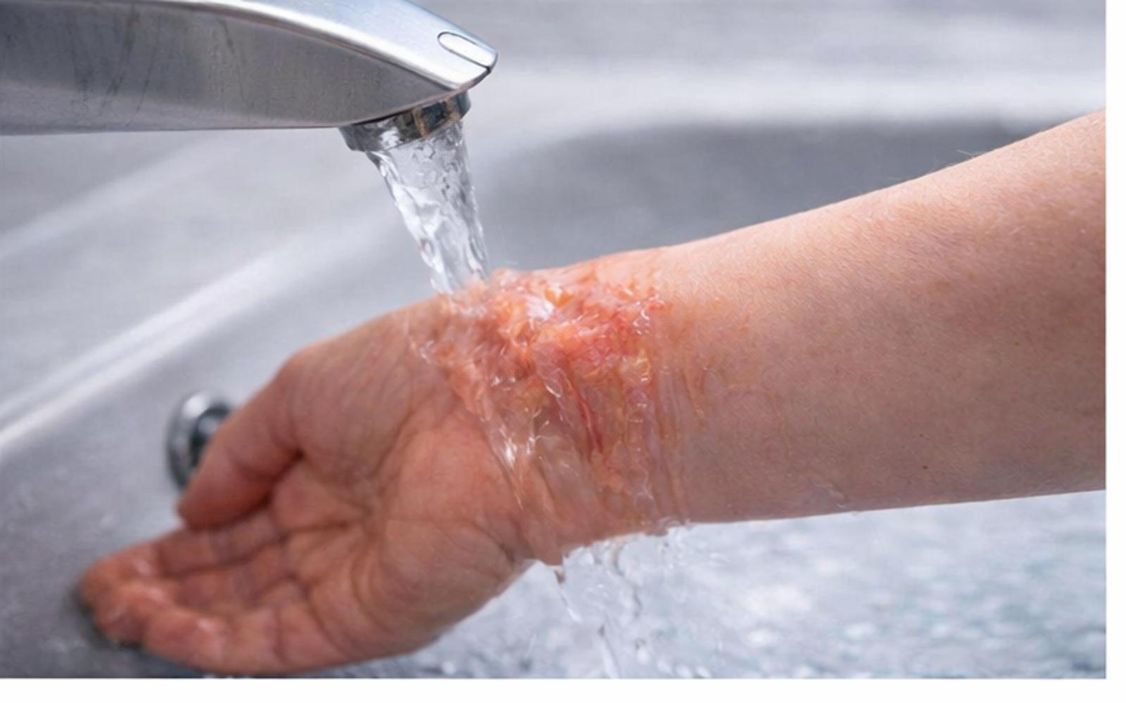 jak ošetřit opaření horkou vodou – chlazení opařeniny pod tekoucí vodou