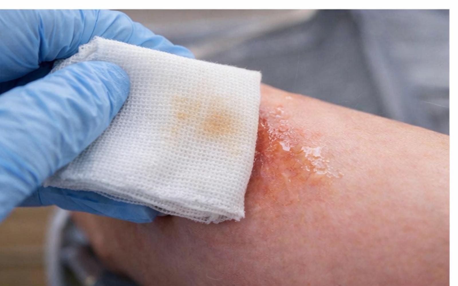 ošetření opařeniny sterilním krytím po opaření horkou vodou