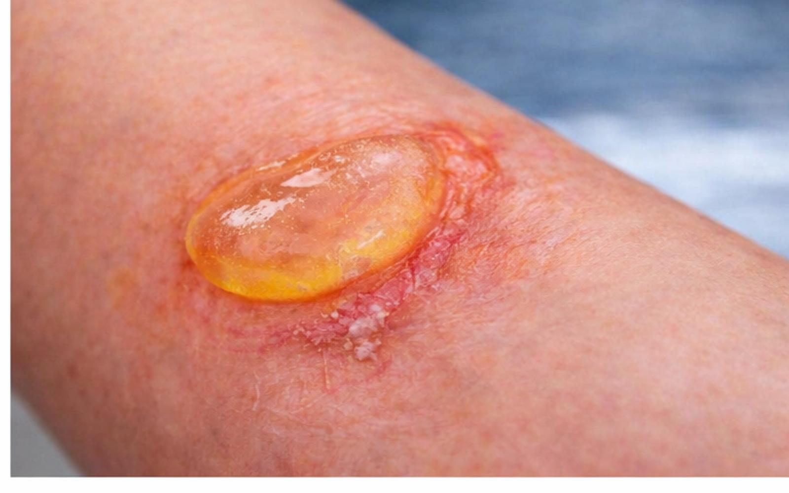 puchyr-po-opareni-kuze