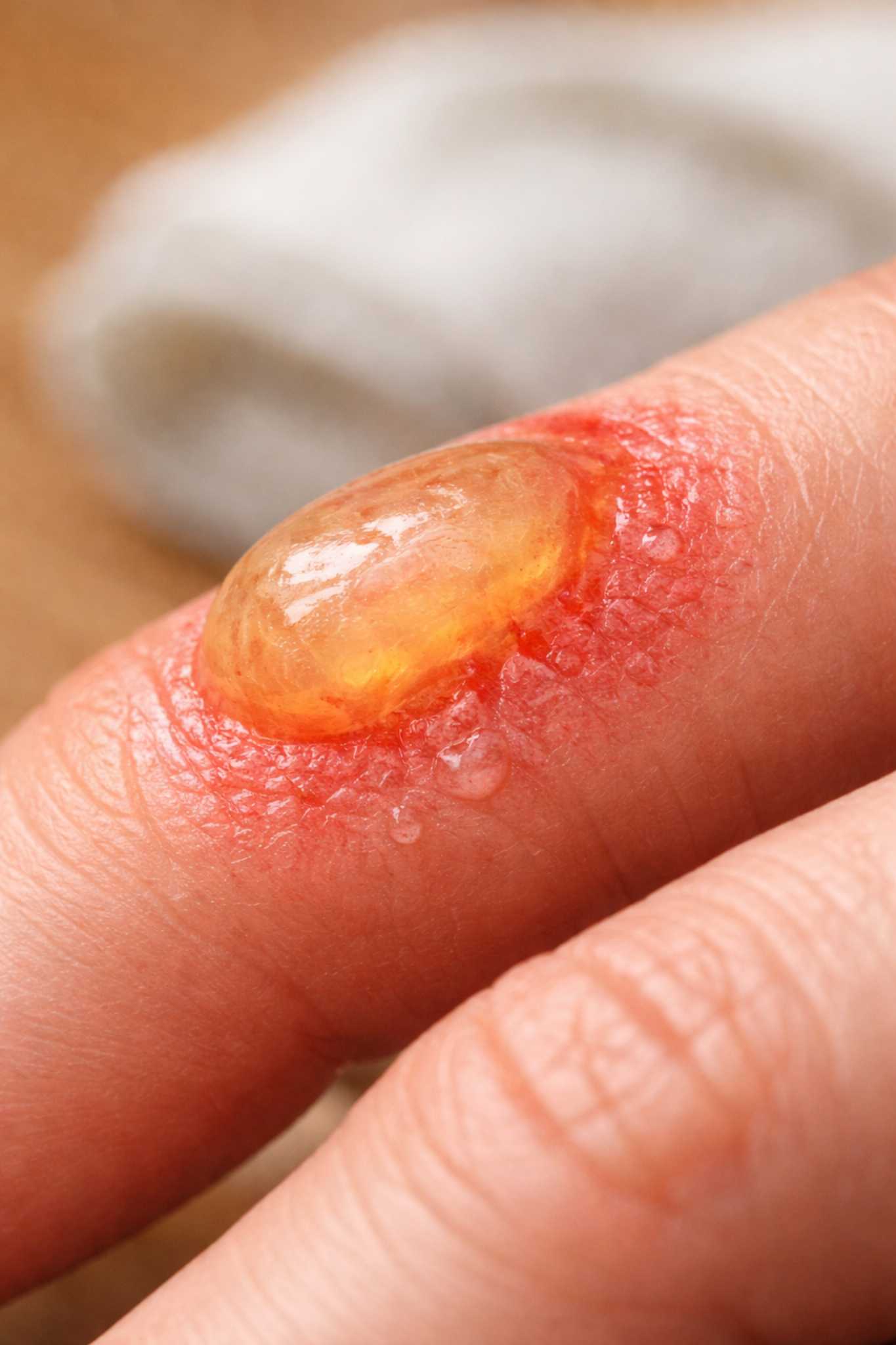 puchýř po popálení na prstu – popálenina druhého stupně