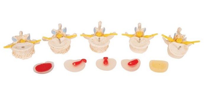 Stádia vyhřeznutí ploténky a degenerace obratlů