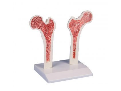 Osteoporóza stehenní kosti