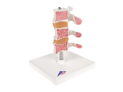 Luxusní model osteoporózy (3 obratle)