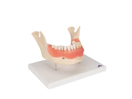 Zubní onemocnění, 2 krát zvětšené