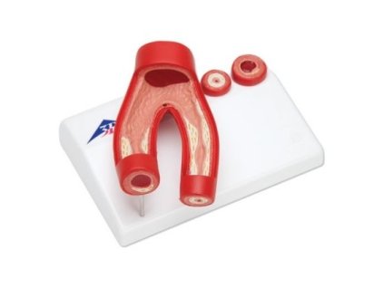 Model arteriosklerózy s průřezem tepny, 2 části