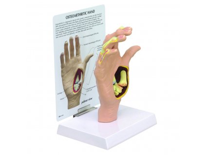 Model ruky s osteoartrózou