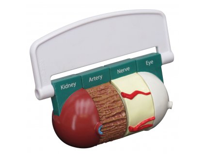 Čtyřdílný model cukrovky