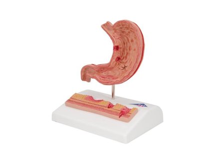 K17 02 Human Stomach Section Model with Ulcers