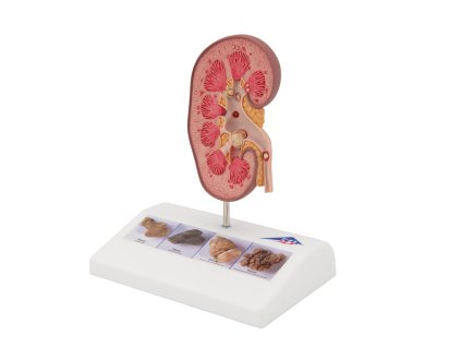 K29 06 1200 1200 Kidney Stone Model 3B Smart Anatomy