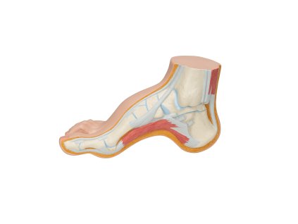 M32 05 1200 1200 Hollow Foot Pes Cavus Model 3B Smart Anatomy
