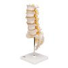 A76 5 05 1200 1200 Human Lumbar Spinal Column Model with Dorso Lateral Prolapsed Intervertebral Disc 3B Smart Anatomy