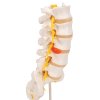A76 5 06 1200 1200 Human Lumbar Spinal Column Model with Dorso Lateral Prolapsed Intervertebral Disc 3B Smart Anatomy