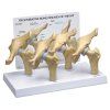 Model čtyř fází osteoartritidy