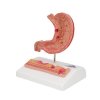 K17 02 Human Stomach Section Model with Ulcers