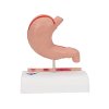 K17 04 Human Stomach Section Model with Ulcers
