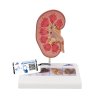K29 01 1200 1200 Kidney Stone Model 3B Smart Anatomy
