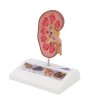 K29 06 1200 1200 Kidney Stone Model 3B Smart Anatomy