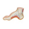 M32 05 1200 1200 Hollow Foot Pes Cavus Model 3B Smart Anatomy