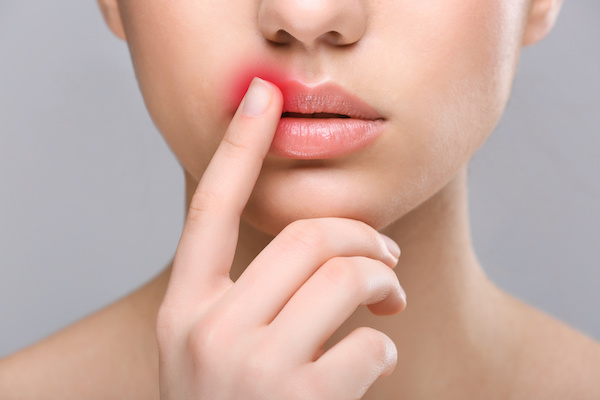 Jak na opary (herpes)?