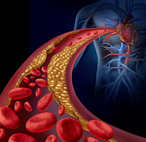 Jak na vysoký cholesterol? CBD Vám může pomoci!