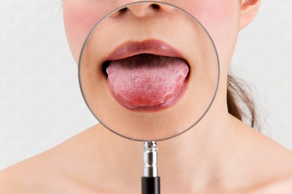 Ako liečiť vredy v ústach?