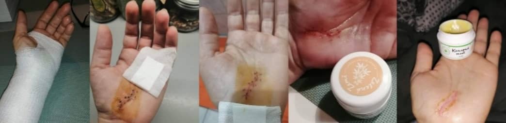 Proces hojenia rany pomocou konopnej masti