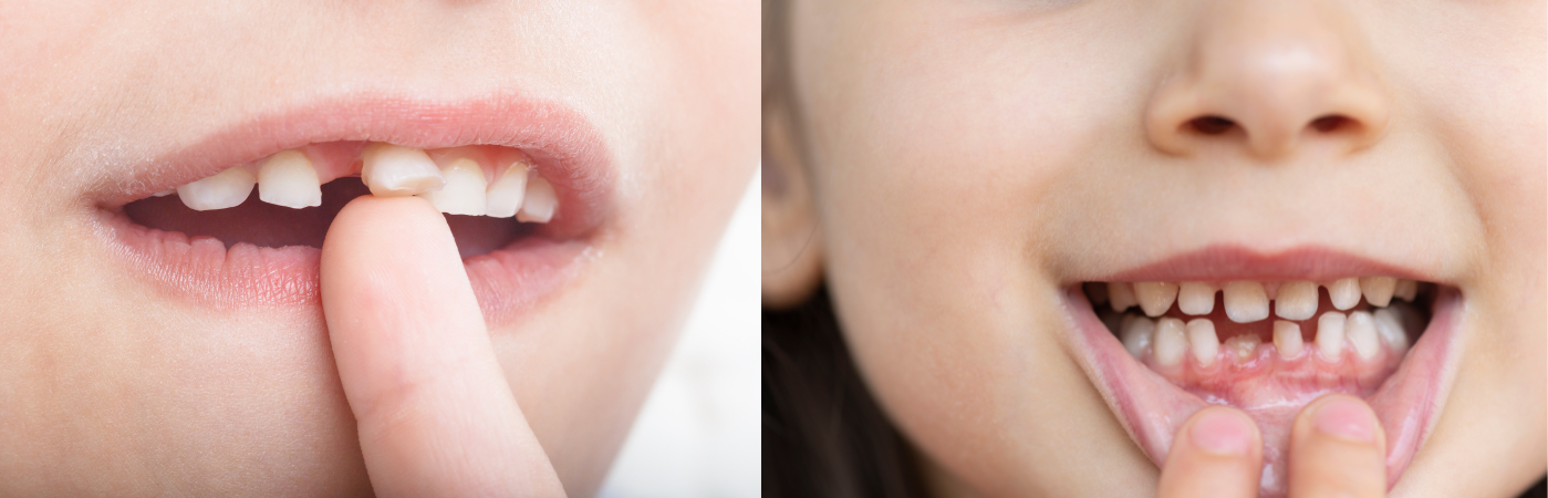 Zoubková  víla-když zoubky padají