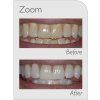 Philips ZOOM! Nite White ACP 16% 3 x 2,4 ml 5+2 zdarma [2] | Zubáček.cz